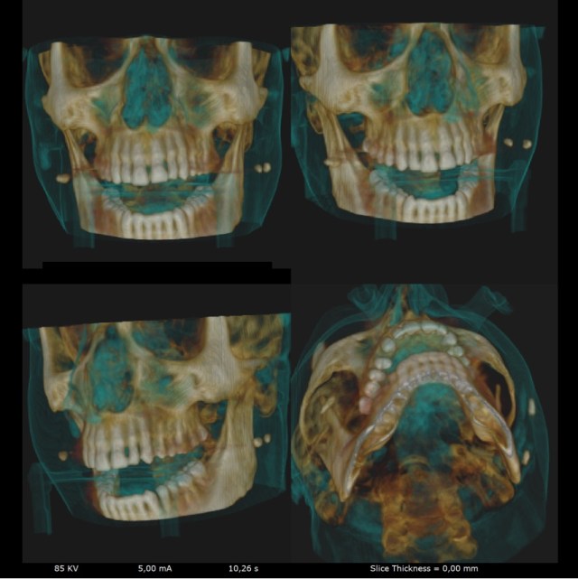 CBCT 3D